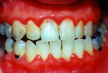 Periodontal Disease Pictures